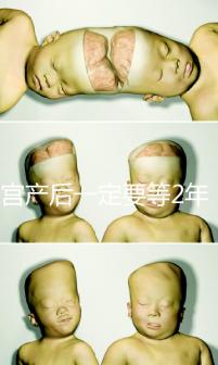 剖宮產后一定要等2年，才能試管嬰兒懷孕嗎？