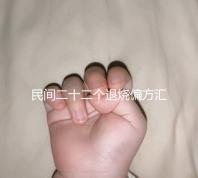 民間二十二個(gè)退燒偏方匯總，生雞蛋清、生姜放腳底還有…