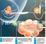 子宮內膜厚度很關鍵，薄了厚了試管嬰兒都難成功